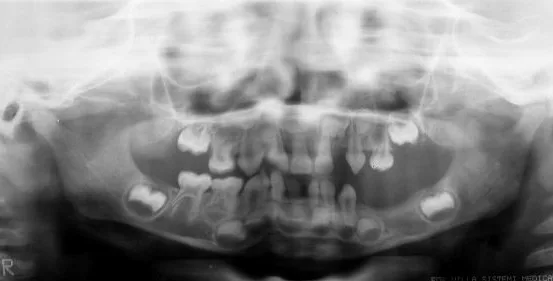Orthopantomogram Bloch-Sulzberger syndrome