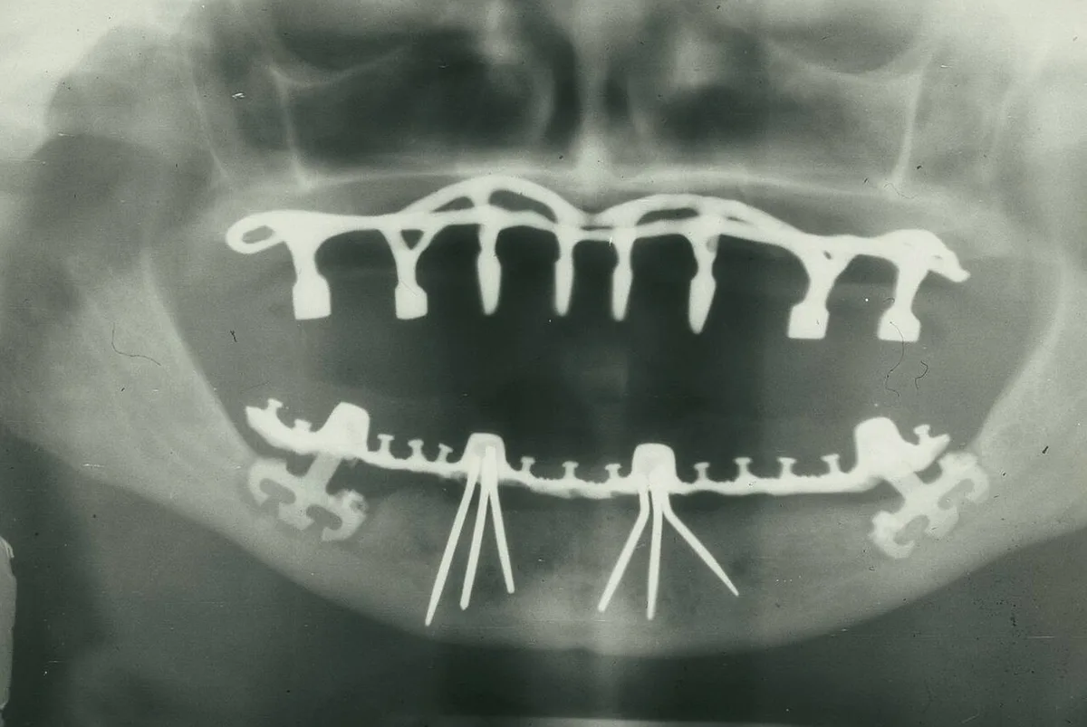 Panoramic radiograph of historic dental implants