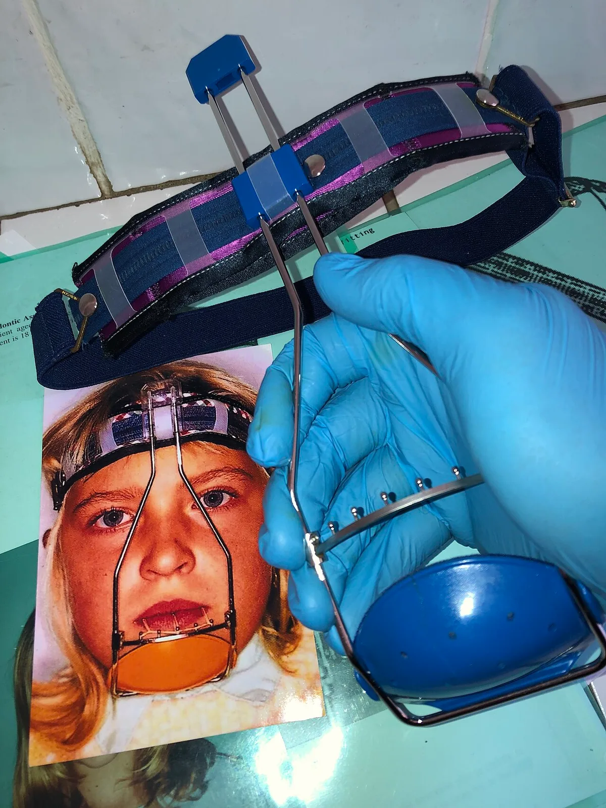 ORTHODONTIC FACE MASK REVERSE-PULL HEADGEAR TÜBINGER MODEL FITTING FOR FEMALE PATIENT 16 HOURS DAILY WEAR