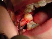 DentalSurgicalExtraction