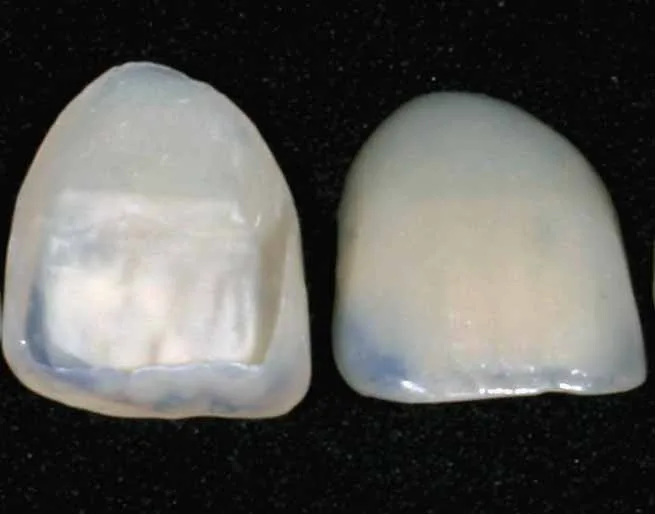 Dental veneer