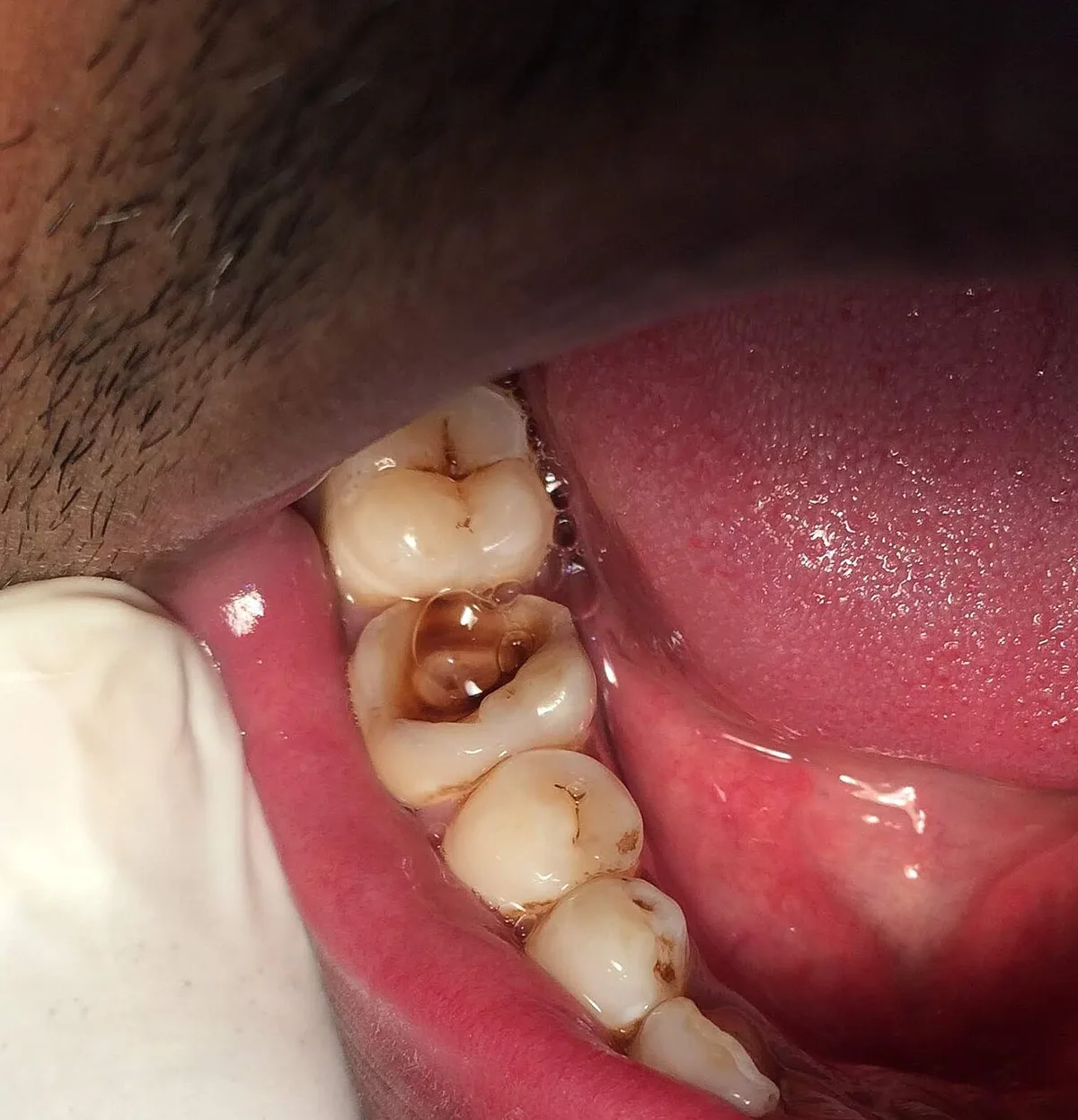 Dental Caries Lower Right First Molar