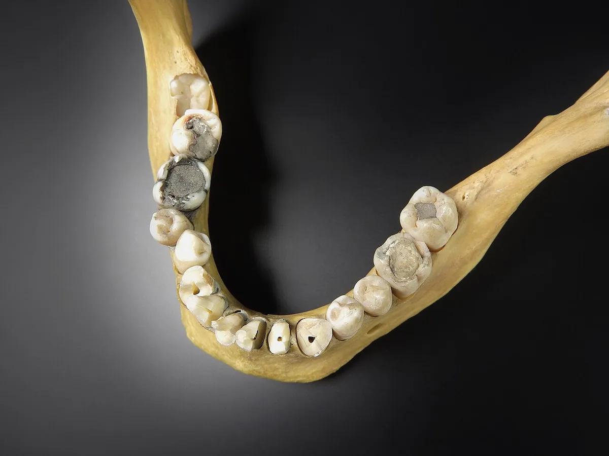 Cranium - mandibula (with dental filling, dentistry)