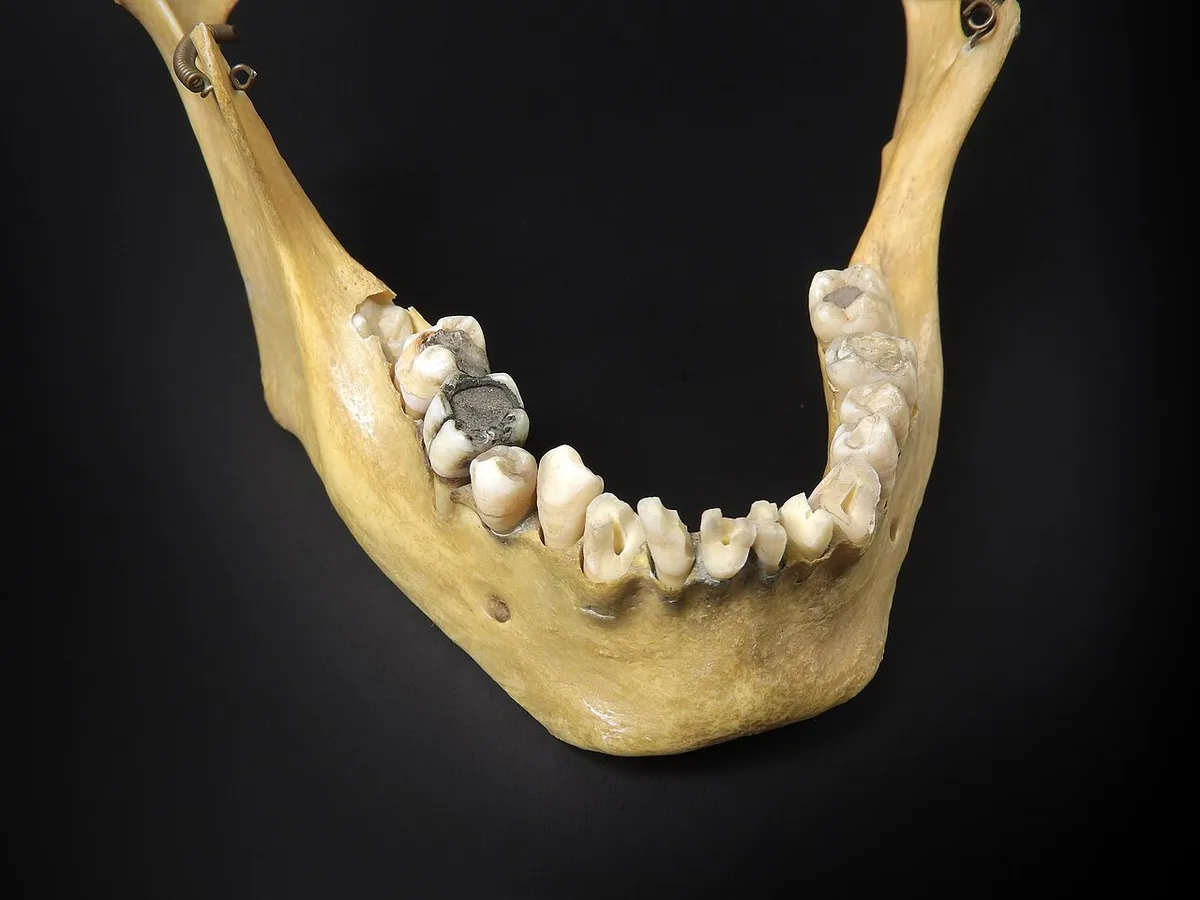 Cranium - mandibula (with dental filling, dentistry) 2