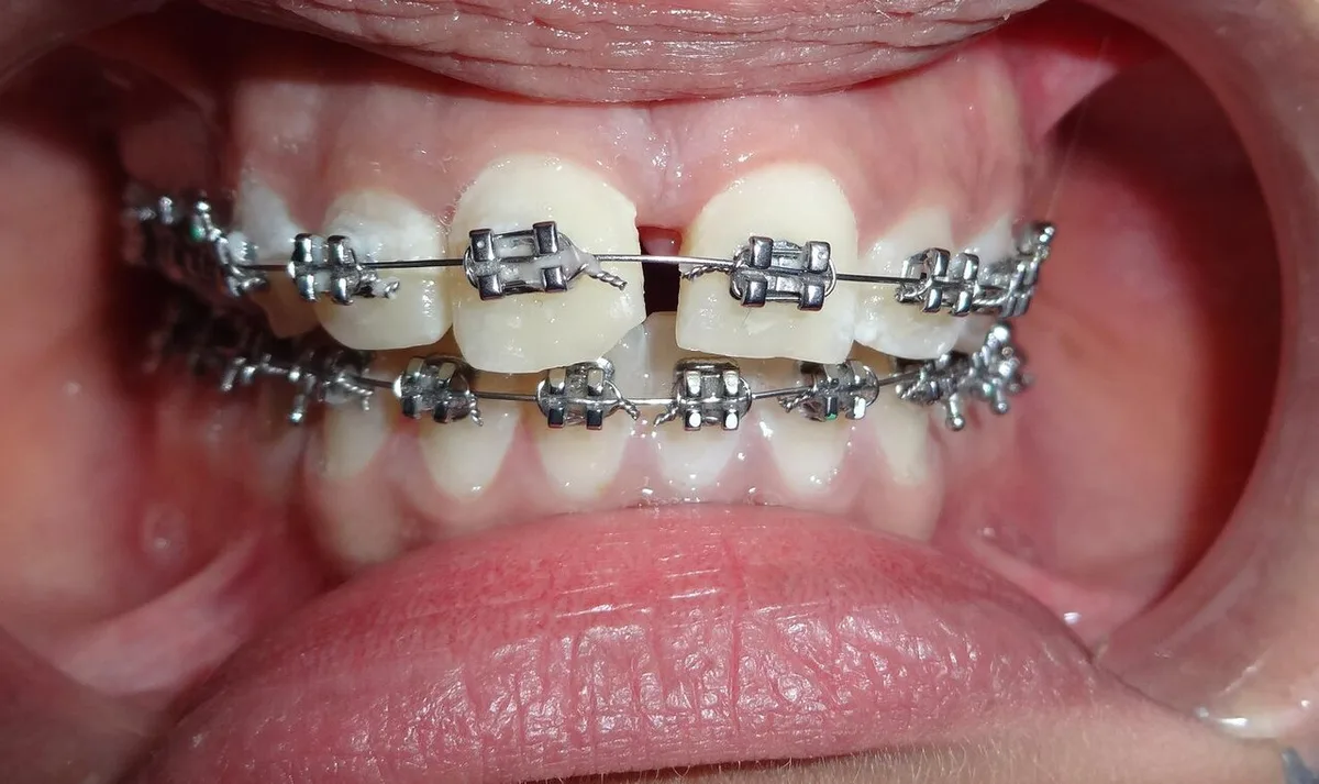 006 fixed orthodontic appliance