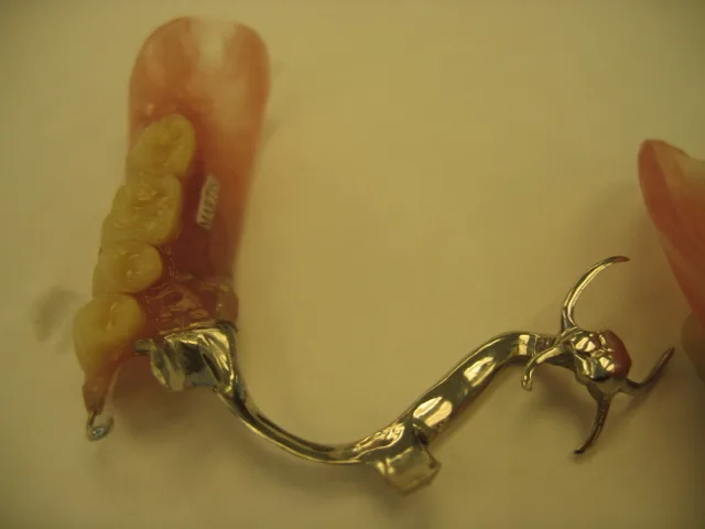 Denture example 2