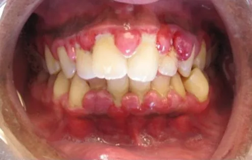 Gingivitis (crop)