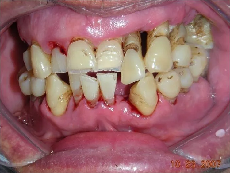 Periodontitis Crónica Severa