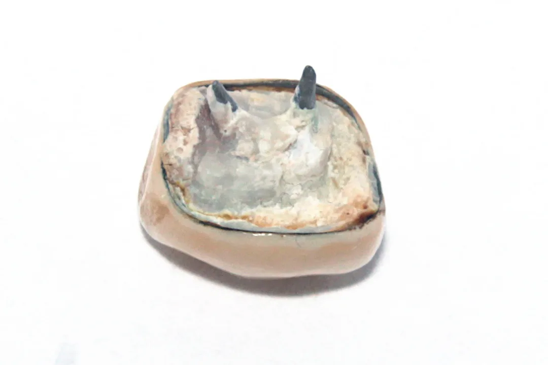Detached-dental-crown-angle-outer