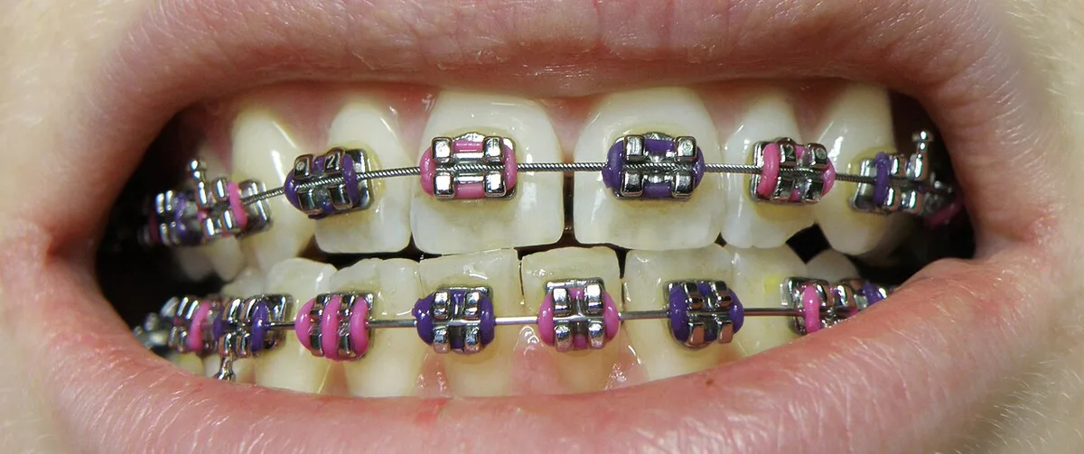 Orthobraces - dental braces lower upper jaw