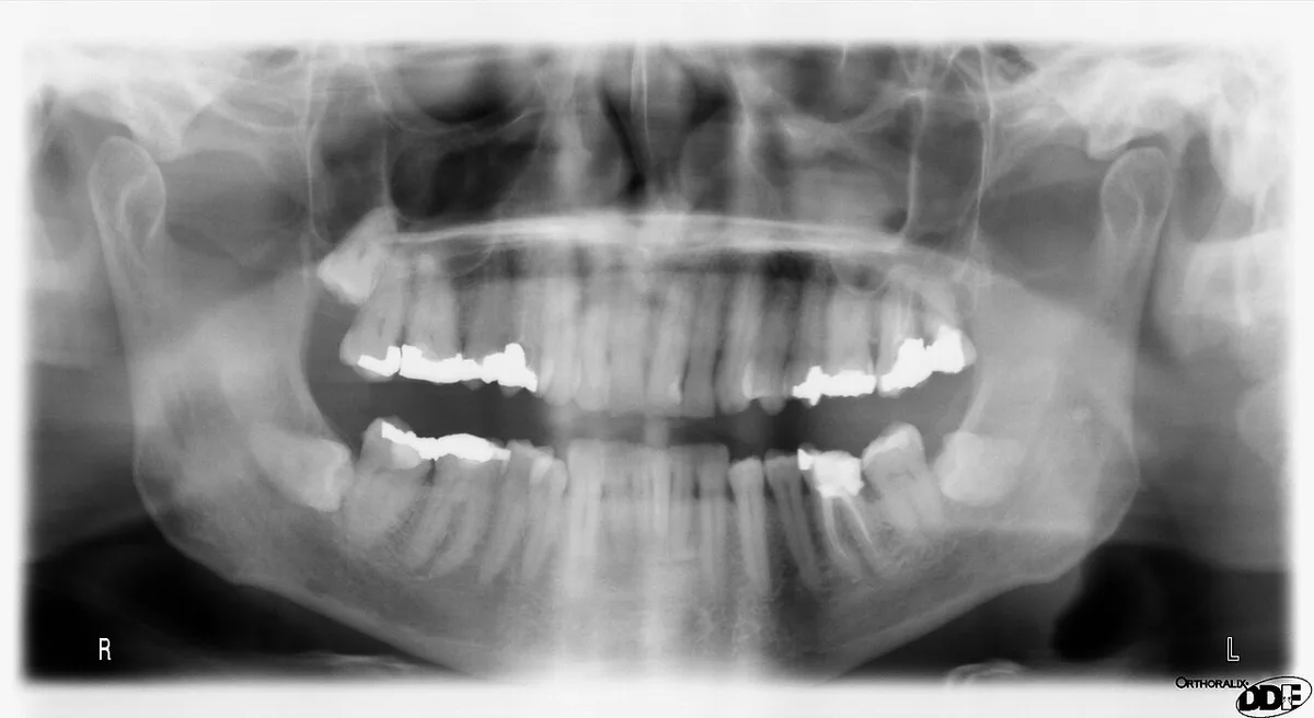 PAN TEETH